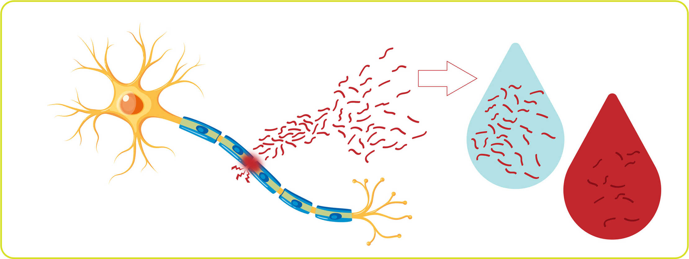 Neurofilamente als Biomarker: Einblick in die Überwachung von Nervenschäden bei MS  Darstellung eines Nervenzell-Schadens mit Austritt von Neurofilamenten (sNFL). Die Grafik zeigt eine beschädigte Nervenzelle mit Myelinverlust, die rote Neurofilament-Fragmente freisetzt. Diese Fragmente gelangen in die Blutbahn, dargestellt durch blaue und rote Tropfen.