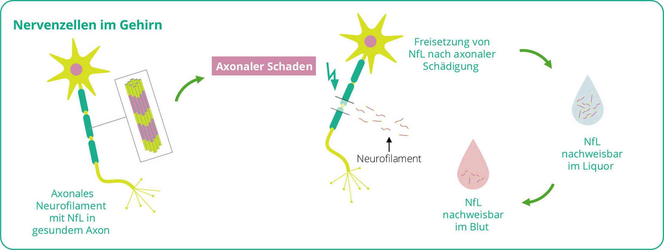 MS & ich sNfL Grafik des axonalen Schaden.