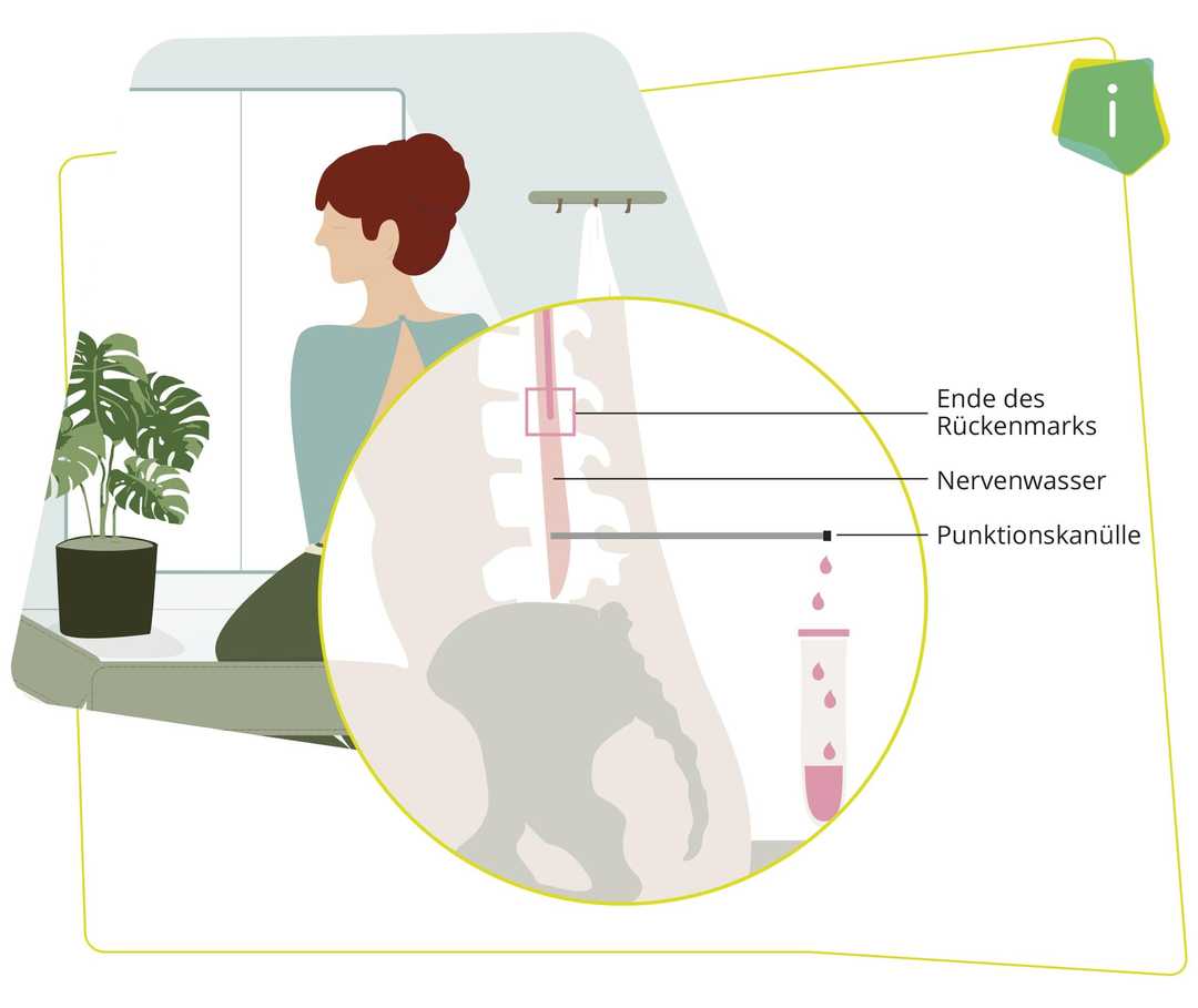 Abbildung: Lumbalpunktion