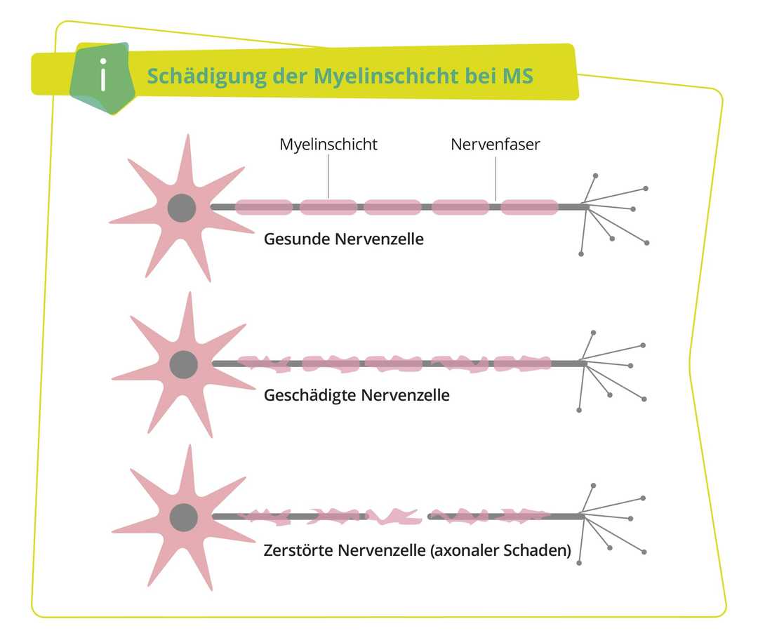 ms-wissen-schaedigung-der myelinschicht-weiss
