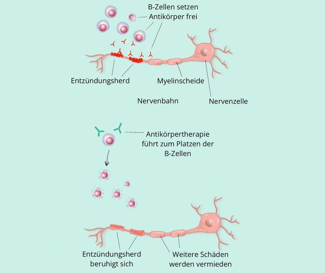 Eine Grafik zur B-Zell-Therapie